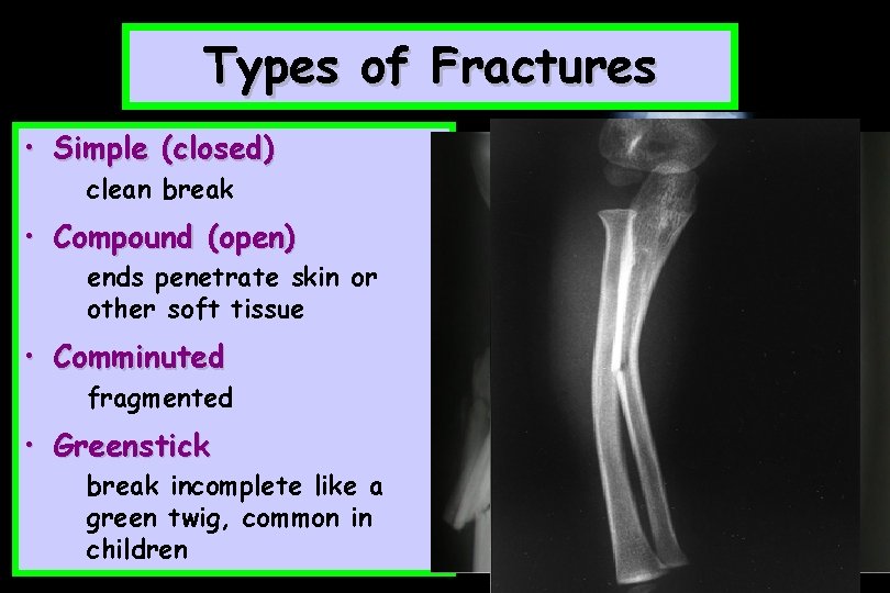Types of Fractures • Simple (closed) clean break • Compound (open) ends penetrate skin