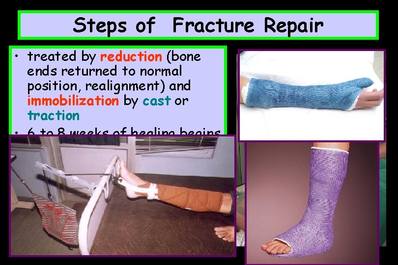 Steps of Fracture Repair • treated by reduction (bone ends returned to normal position,