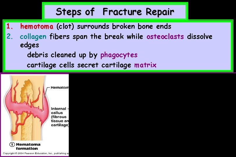 Steps of Fracture Repair 1. hemotoma (clot) surrounds broken bone ends 2. collagen fibers