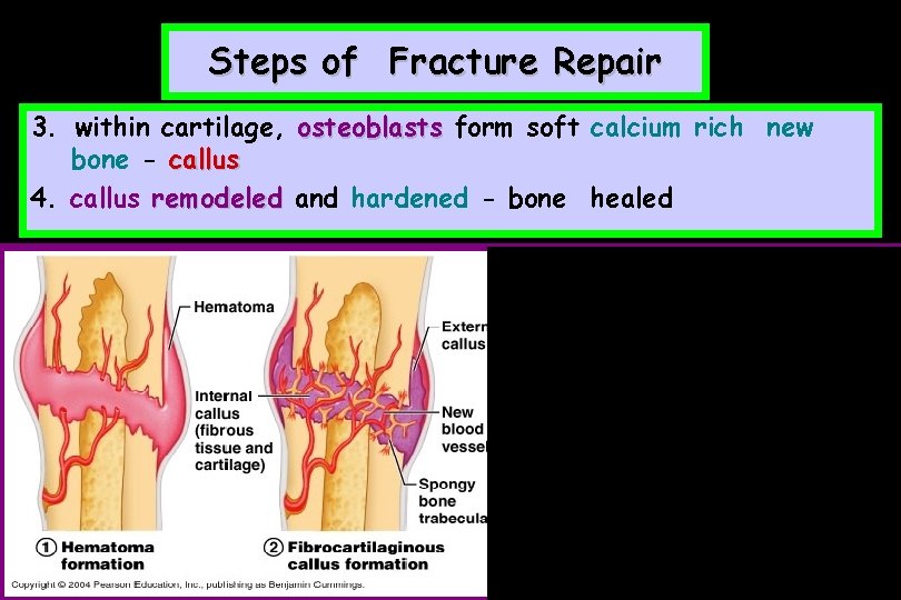 Steps of Fracture Repair 3. within cartilage, osteoblasts form soft calcium rich new bone