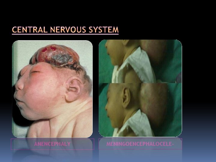 ANENCEPHALY MENINGOENCEPHALOCELE- 