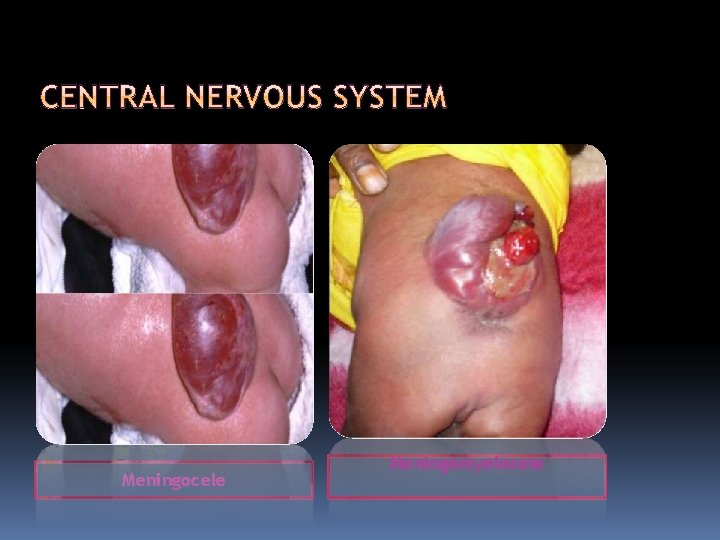 Meningocele Meningomyelocele 
