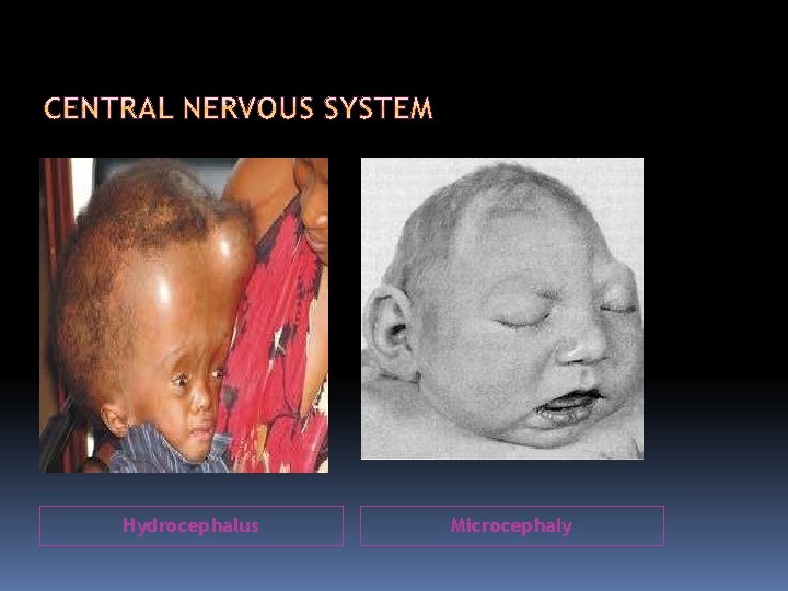 Hydrocephalus Microcephaly 