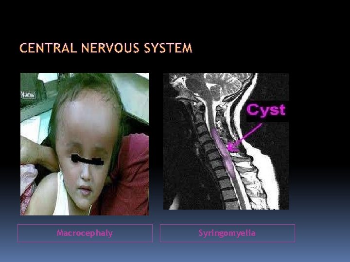 Macrocephaly Syringomyelia 