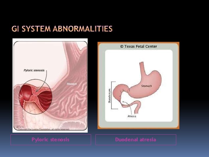Pyloric stenosis Duodenal atresia 