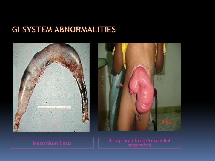 Meconium ileus Hirscprung disease(congenital megacolon) 