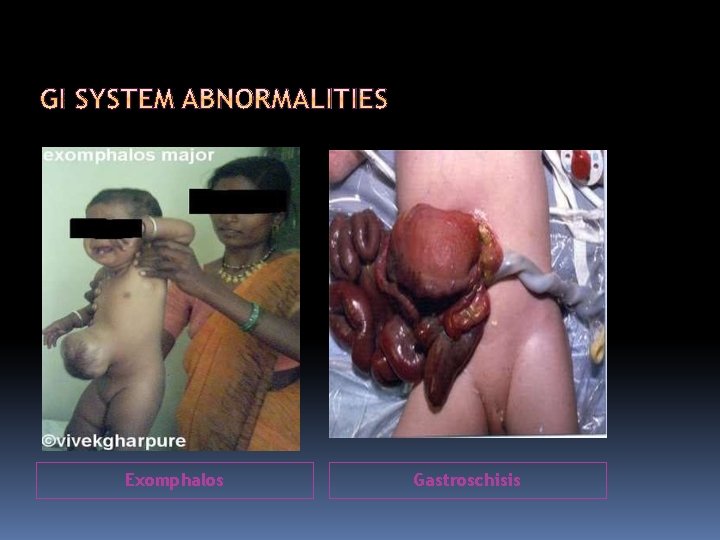 Exomphalos Gastroschisis 