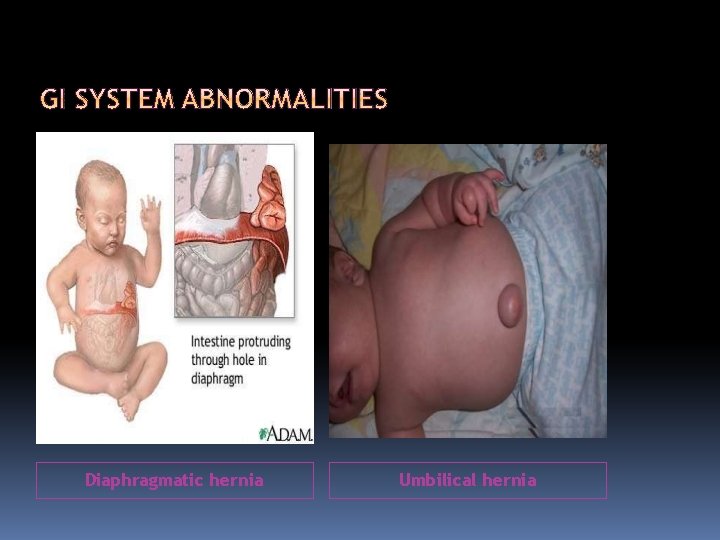 Diaphragmatic hernia Umbilical hernia 