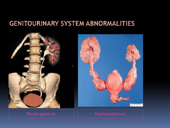 Renal agenesis Hydronephrosis 