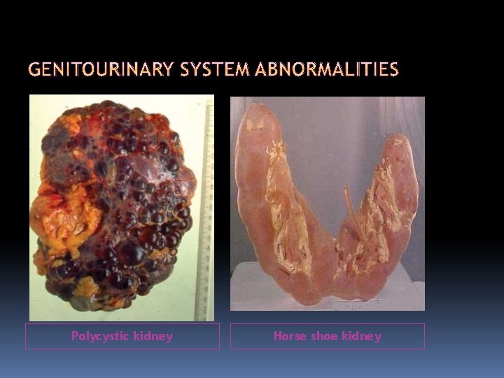 Polycystic kidney Horse shoe kidney 