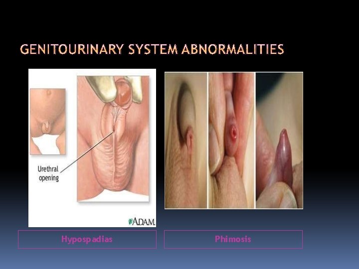 Hypospadias Phimosis 