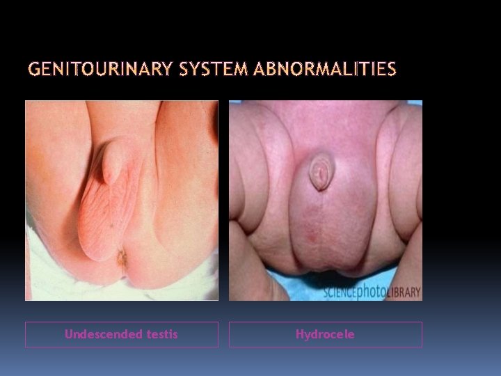 Undescended testis Hydrocele 