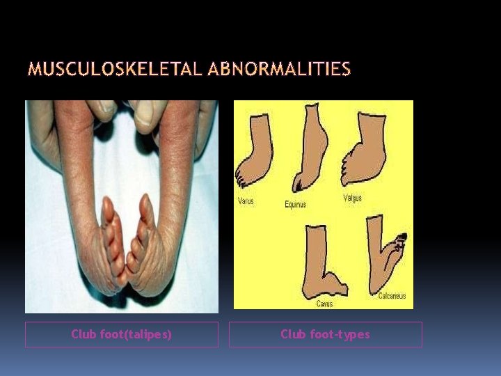 Club foot(talipes) Club foot-types 