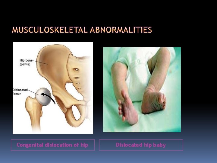Congenital dislocation of hip Dislocated hip baby 