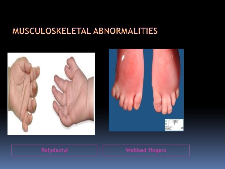 Polydactyl Webbed fingers 