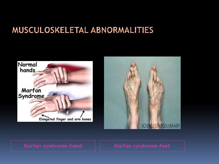 Marfan syndrome-hand Marfan syndrome-feet 