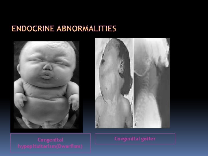 Congenital hypopituitarism(Dwarfism) Congenital goiter 