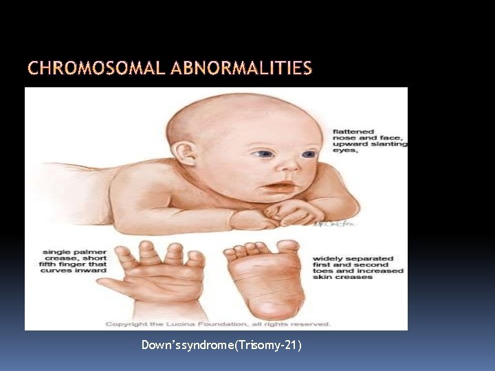  Down’s syndrome(Trisomy-21) 