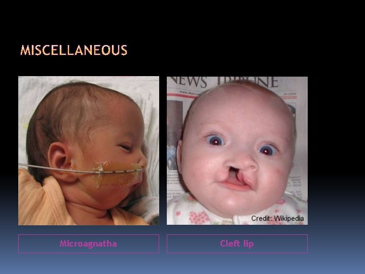 Microagnatha Cleft lip 