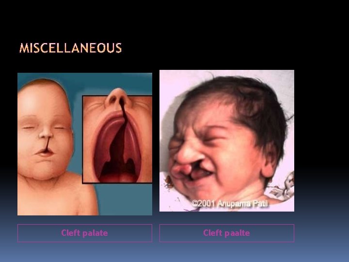 Cleft palate Cleft paalte 