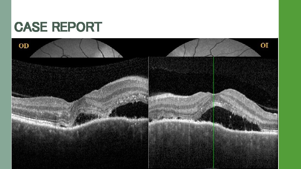CASE REPORT Medical Record • CC: A healthy 51 -year-old female. Blurry vision, metamorphopsia
