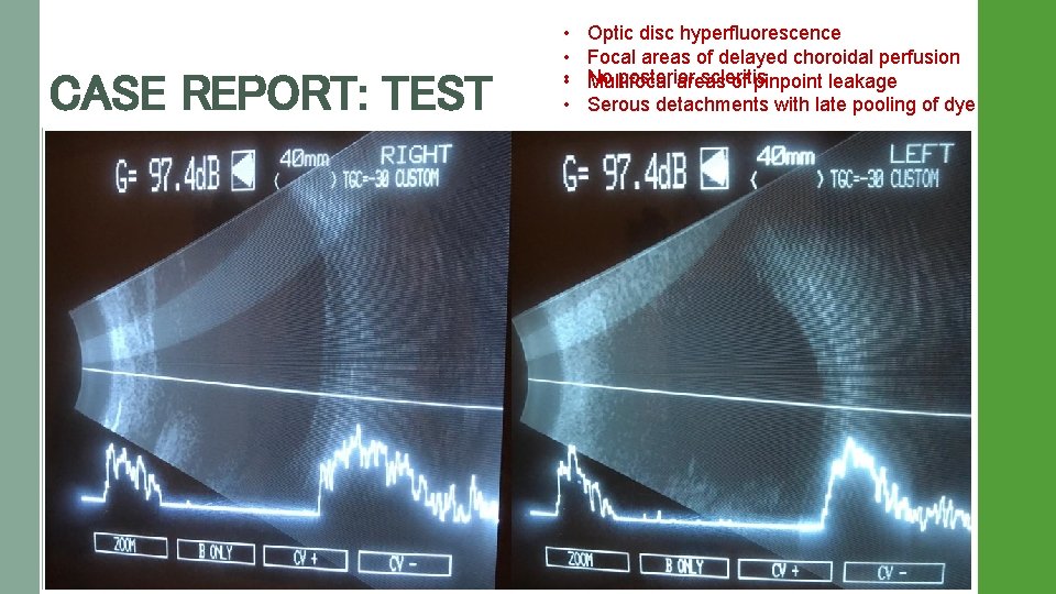  • • CASE REPORT: TEST Optic disc hyperfluorescence Focal areas of delayed choroidal