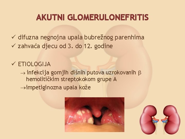 AKUTNI GLOMERULONEFRITIS ü difuzna negnojna upala bubrežnog parenhima ü zahvaća djecu od 3. do