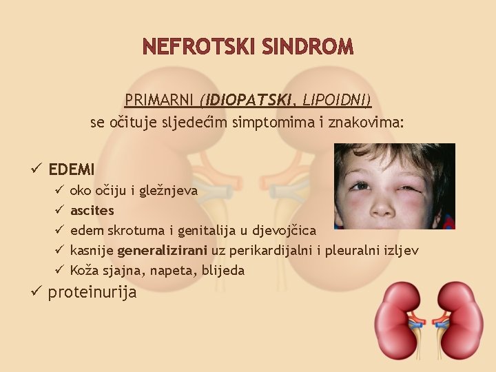 NEFROTSKI SINDROM PRIMARNI (IDIOPATSKI, LIPOIDNI) se očituje sljedećim simptomima i znakovima: ü EDEMI ü