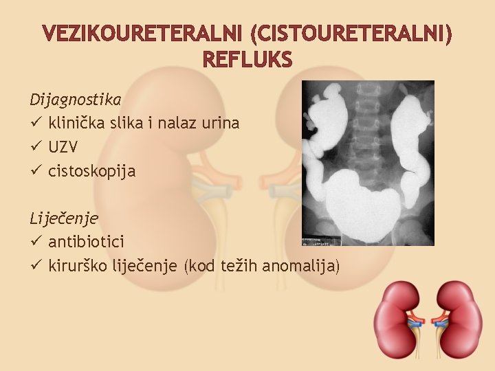 VEZIKOURETERALNI (CISTOURETERALNI) REFLUKS Dijagnostika ü klinička slika i nalaz urina ü UZV ü cistoskopija