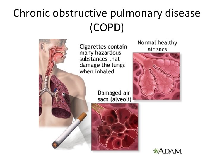 Chronic obstructive pulmonary disease (COPD) 