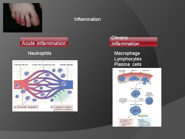 Inflammation Acute inflammation Neutrophils Chronic inflammation Macrophage Lymphocytes Plasma cells 