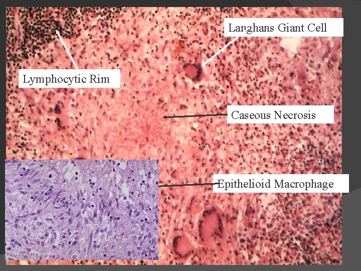 Granuloma Langhans Giant Cell Lymphocytic Rim Caseous Necrosis Epithelioid Macrophage 