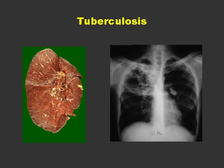 Tuberculosis 