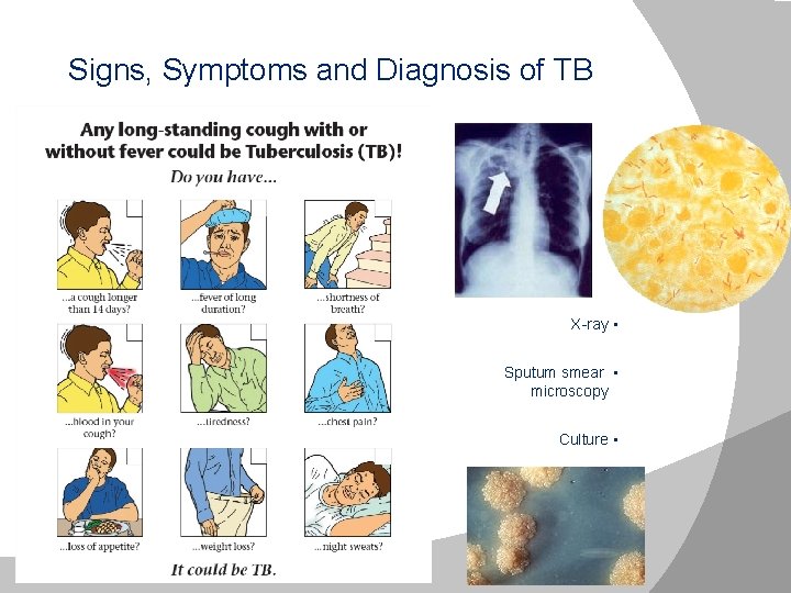 Signs, Symptoms and Diagnosis of TB X-ray • Sputum smear • microscopy Culture •