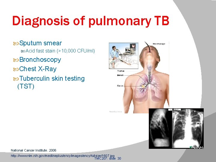 Diagnosis of pulmonary TB Sputum smear Acid fast stain (>10, 000 CFU/ml) Bronchoscopy Chest