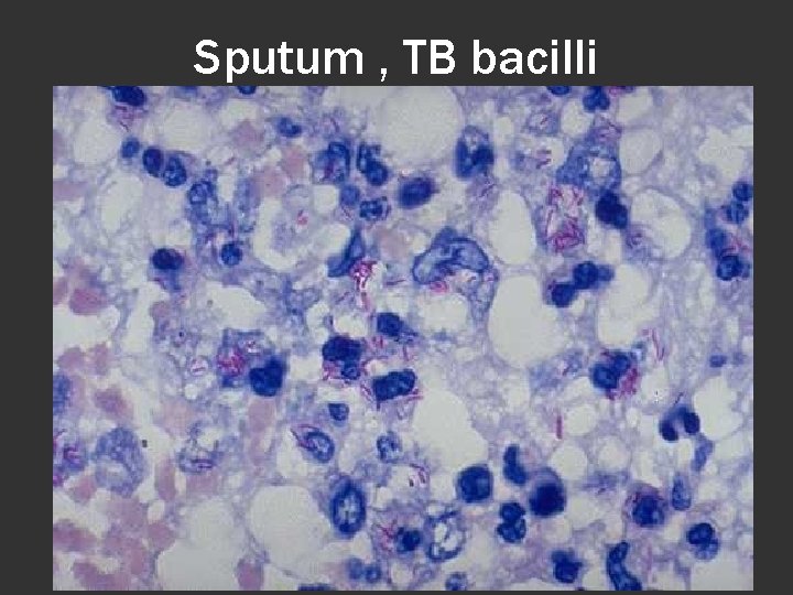 Sputum , TB bacilli 