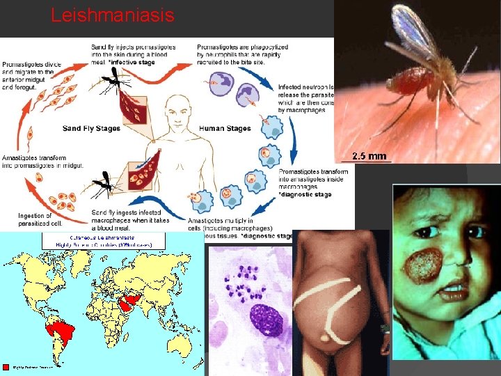 Leishmaniasis 