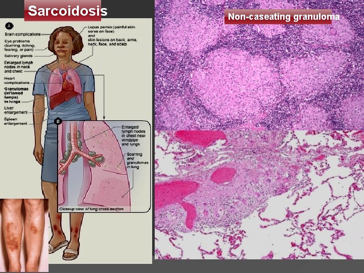 Sarcoidosis Non-caseating granuloma 