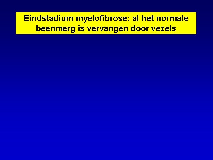 Eindstadium myelofibrose: al het normale beenmerg is vervangen door vezels 