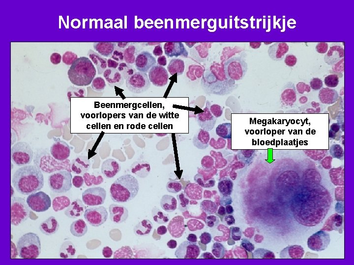 Normaal beenmerguitstrijkje Beenmergcellen, voorlopers van de witte cellen en rode cellen Megakaryocyt, voorloper van