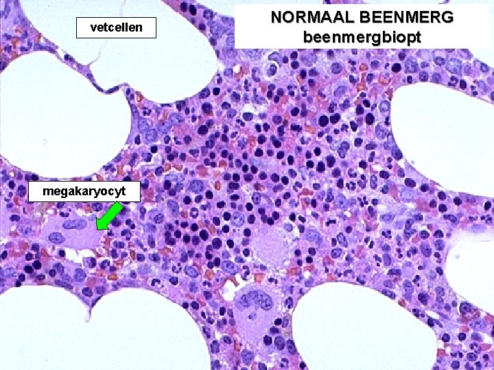 vetcellen megakaryocyt NORMAAL BEENMERG beenmergbiopt 