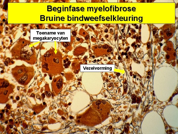 Beginfase myelofibrose Bruine bindweefselkleuring Toename van megakaryocyten Vezelvorming 