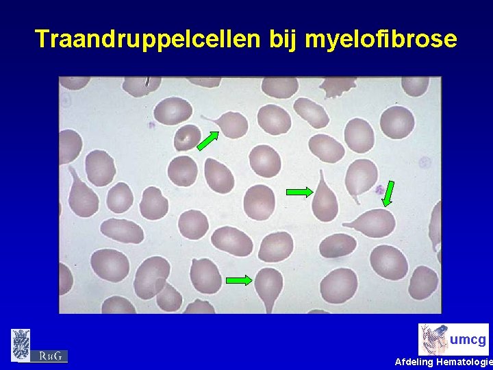 Traandruppelcellen bij myelofibrose umcg Afdeling Hematologie 