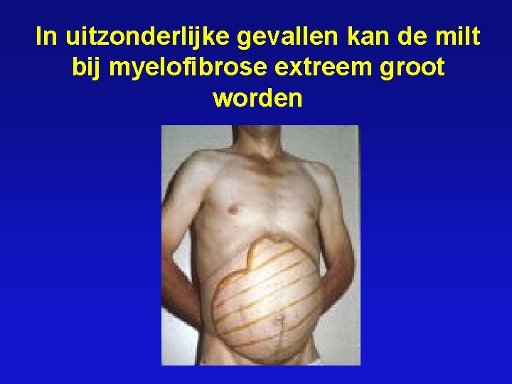 In uitzonderlijke gevallen kan de milt bij myelofibrose extreem groot worden 