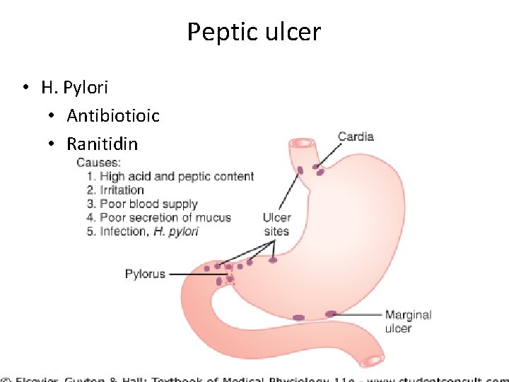 Peptic ulcer • H. Pylori • Antibiotioic • Ranitidin 