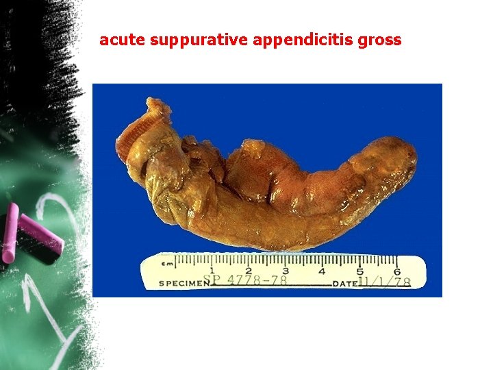 acute suppurative appendicitis gross 