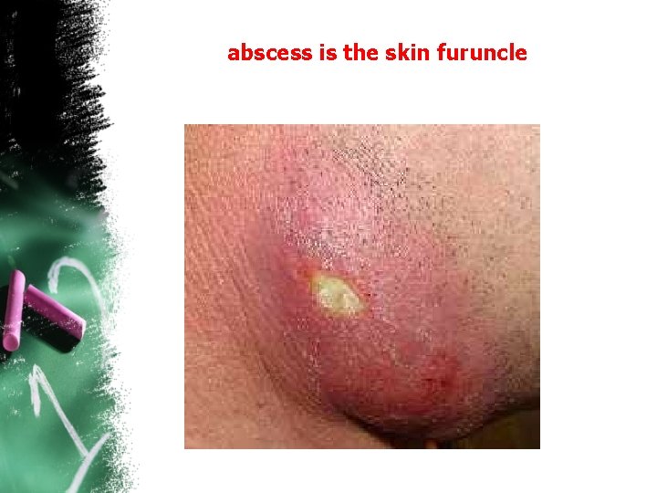 abscess is the skin furuncle 