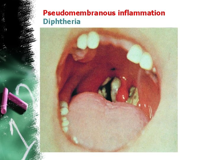 Pseudomembranous inflammation Diphtheria 