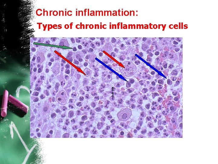 Chronic inflammation: Types of chronic inflammatory cells 1 1 