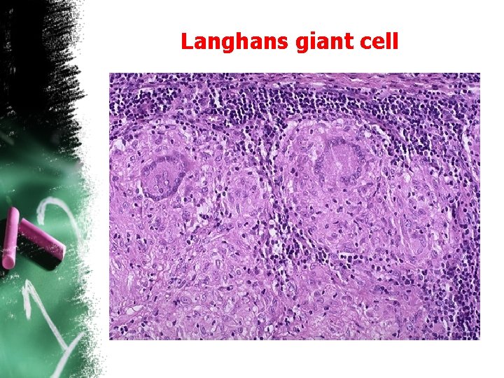 Langhans giant cell 
